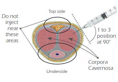 Injection Therapy Guide for Erectile Dysfunction