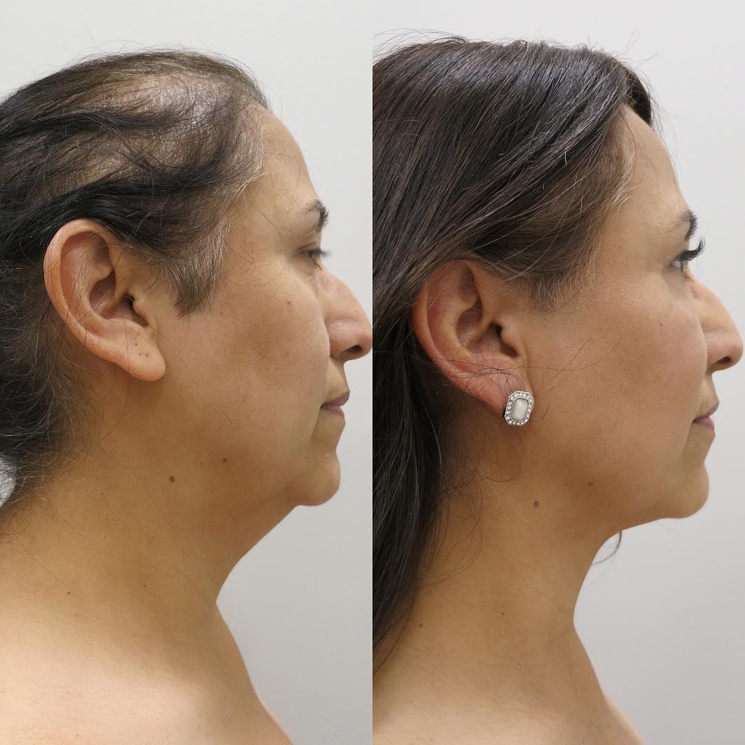 neck liposuction cost houston