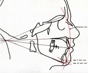 Lat Ceph x-ray analysis