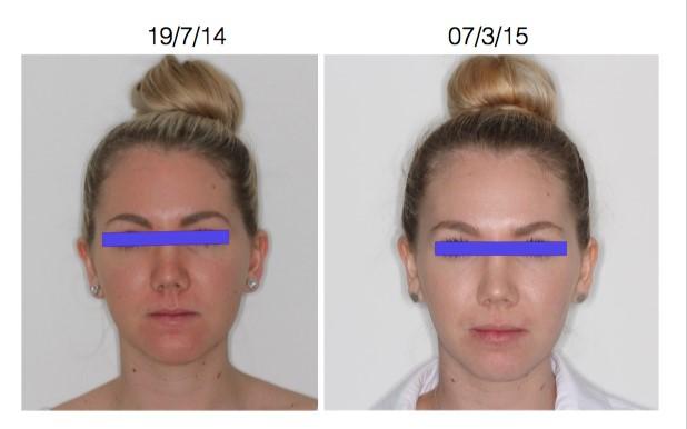 Before and after jaw expansion front view